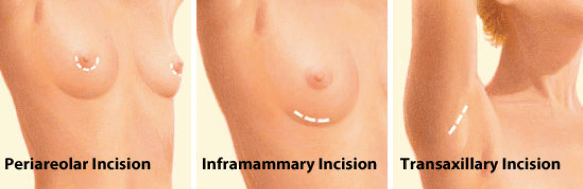 breast implants cyprus limassol nicosia.jpg